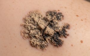 Verrue séborrhéique sur la peau, montrant sa texture et couleur caractéristiques
